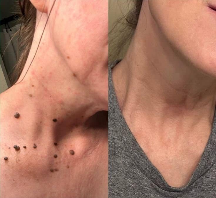 Skin Tags Removals